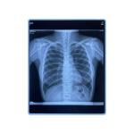 CE Printable Blue Medical X Ray Film 11x14 Inch Pet Inkjet Film