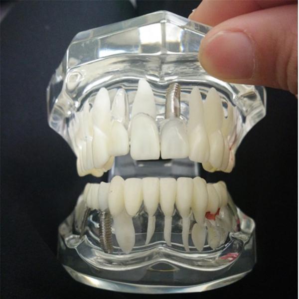 Removable Dental Materials Activity Pathological Teeth Model