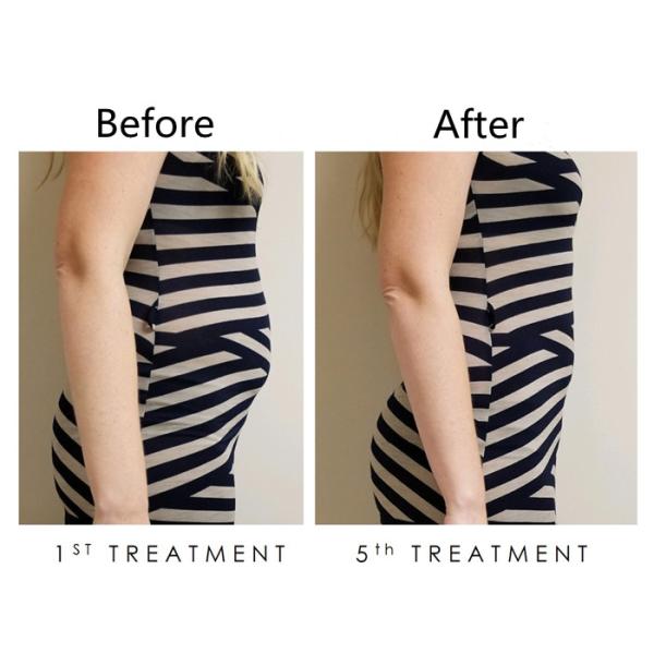 360 Degree Cryolipolysis Coolsculpting Machine Aesthetics Slimming