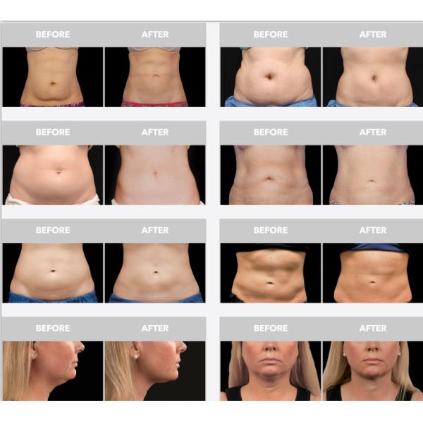 Body Slimming Machine Offering Non Surgical Solution for Fat Reduction on Abdomen Love Handles and Double Chin