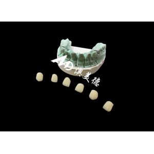 Emax Ceramic Crown Customizable and Affordable Solution for Dental Restoration