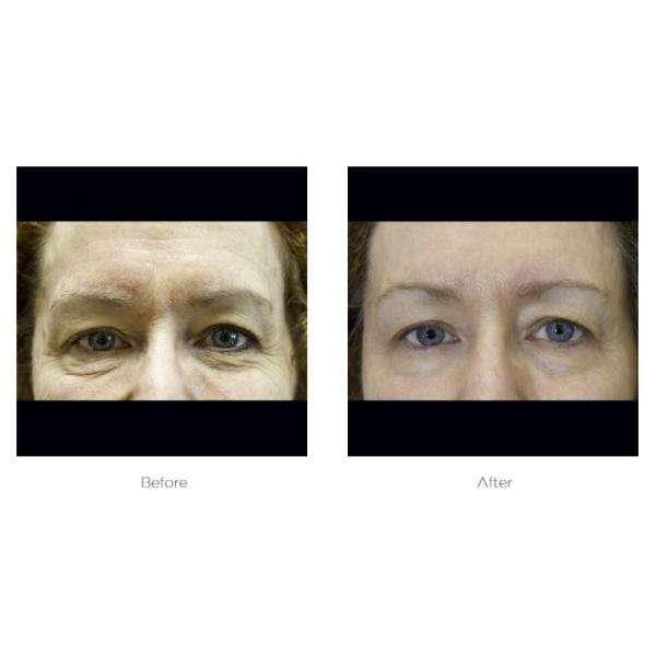Elite Ultra 360_Before_and_After_photos_Eyes