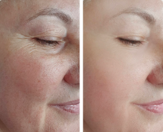 Botulinum Toxin Type A Injection 100Unit Allergan Dermal Filler