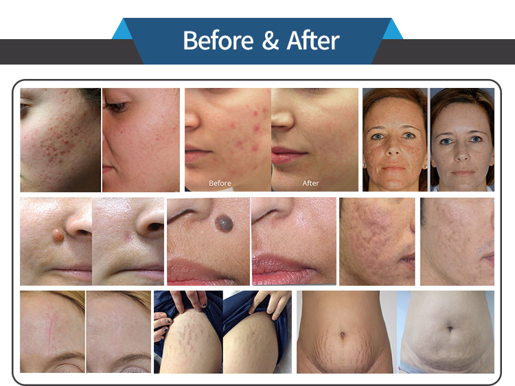 Co2 Fractional Laser Machine For Skin Stretch Mark Scar Removal Acne Treatment
