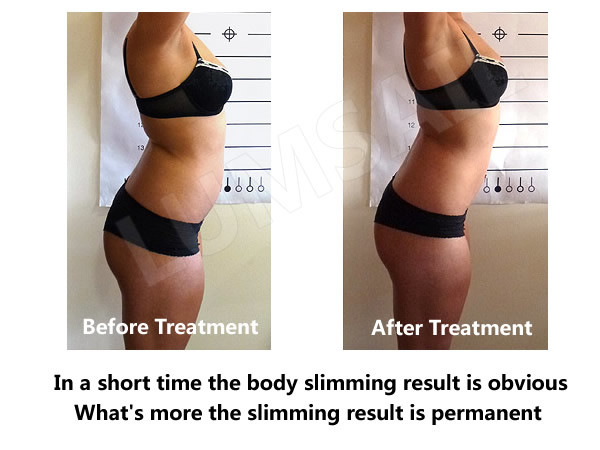 Cellulite Reduction Cryolipolysis Body Slimming Machine With High Pressure Vacuum Suction