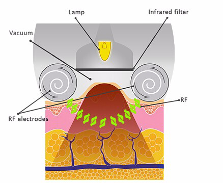 Kuma shape/ Body Cavitation Vacuum Shaping Machine/ laser slimming machine/epiderma