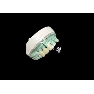 Emax Ceramic Crown Customizable and Affordable Solution for Dental Restoration