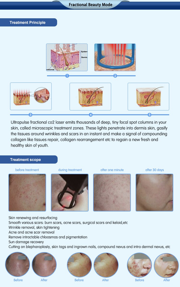 2016 laser equipment vaginal rejuvenation skin rejuvenation medical surgical 10600nm fractional co2 laser system machine