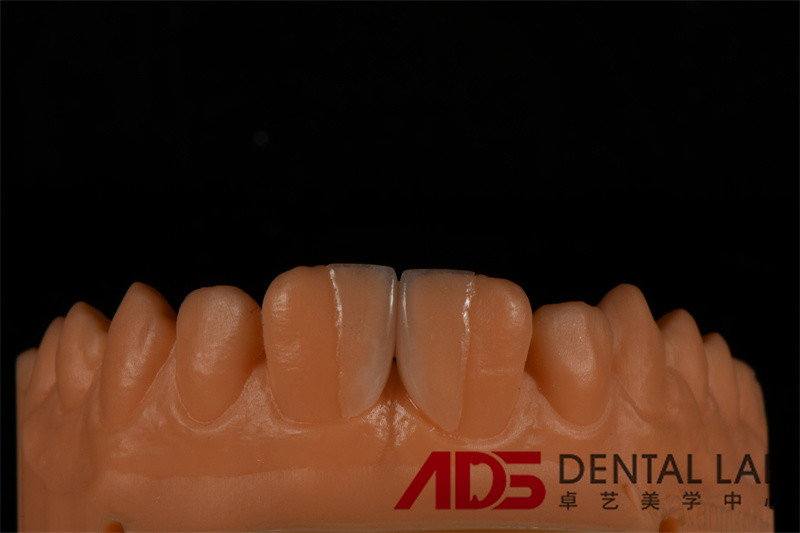 Dentures Aesthetic Emax All Ceramic Crowns Front Teeth OEM
