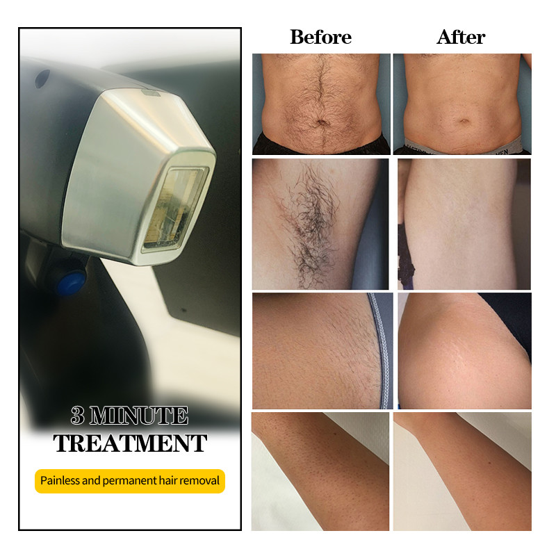 Beauty Salon Medical Hospital 808 Laser Hair Removal Machine Permanent Painless
