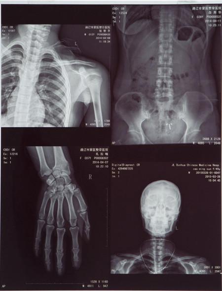 11X14 Inch Medical X-ray Film/Analogue Medical Film/Dry Film