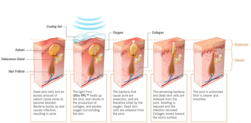 OPT Advanced SHR IPL Technology Permanent Hair Removal and Wrinkle Removal