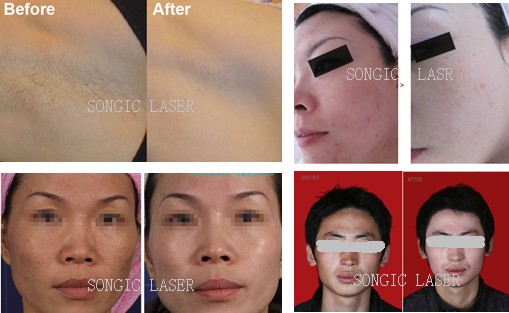CE Approval Portable IPL RF Salon Use IPL Hair Removal Machine
