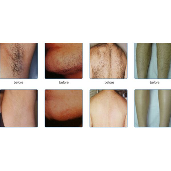 Laser Diode Hair Removal Machine