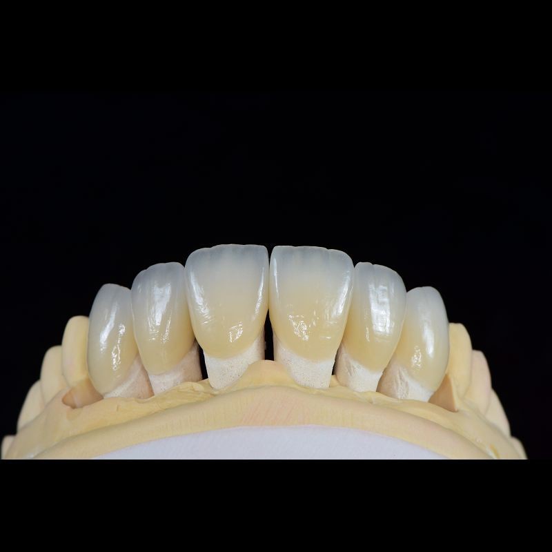 Quality Dental Lab Teeth Feldspathic Porcelain Veneers Custom Shaped for sale