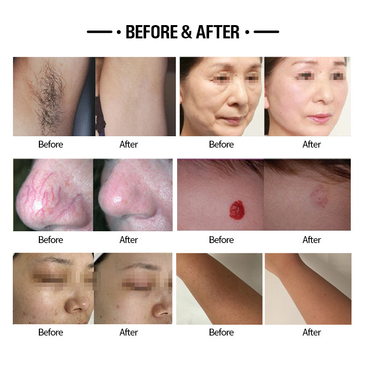 Power 2000W Alex Laser Machine For Vascular Anomalies