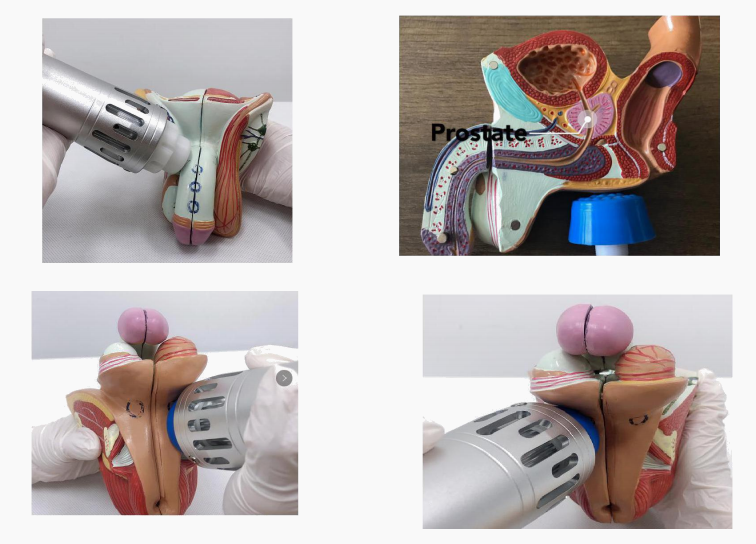 shockwave ed therapy