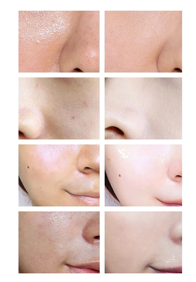 Acne Whitening Facial Skincare Set Cleanser Toner And Moisturizer With Papaya Extract Whitening