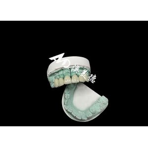 Emax Ceramic Crown Customizable and Affordable Solution for Dental Restoration